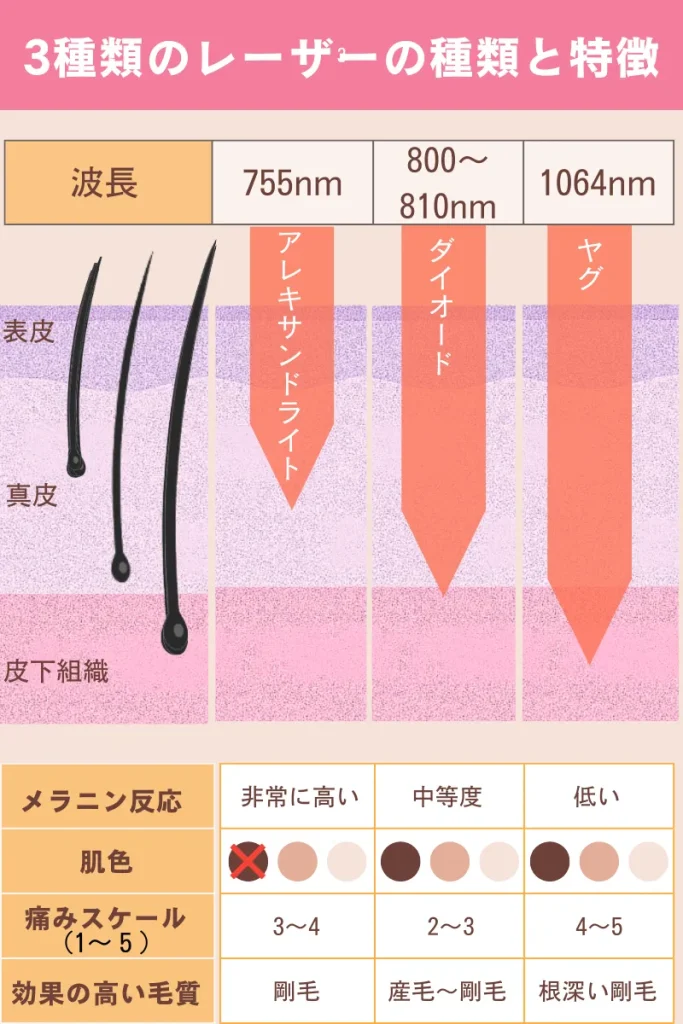 医療脱毛_レーザーの種類