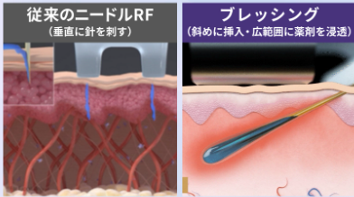 ブレッシングの特徴