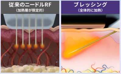 ブレッシングの特徴