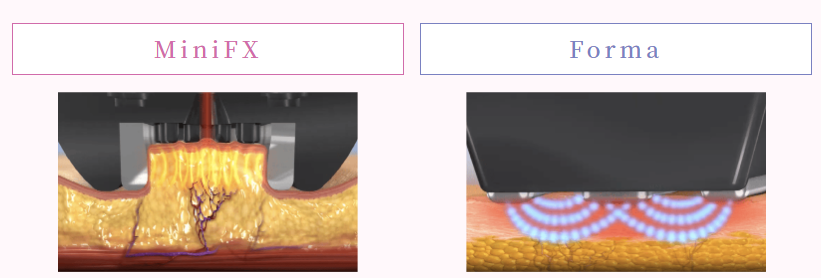 インモードミニFXとフォーマのダウンタイムの違い