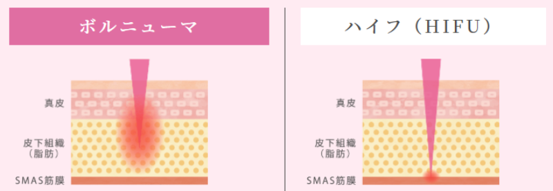 ボルニューマとハイフの違い