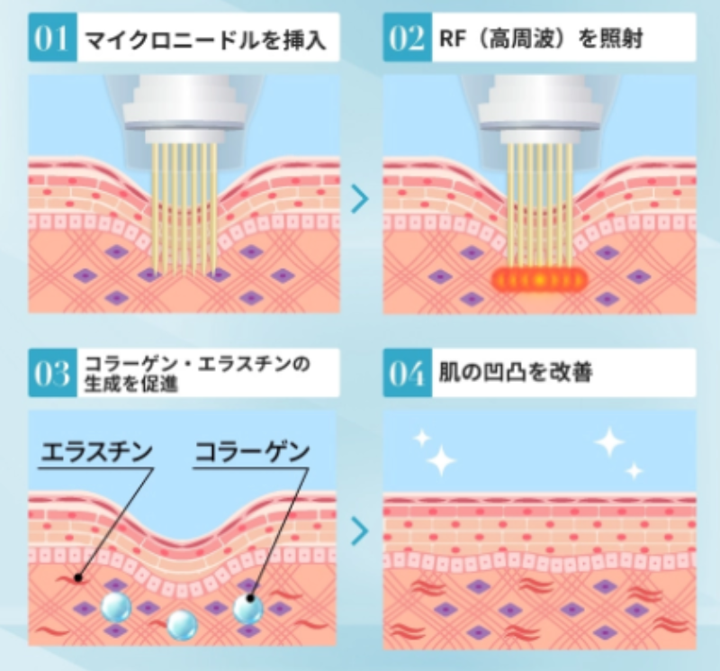 エリシスセンスの仕組み