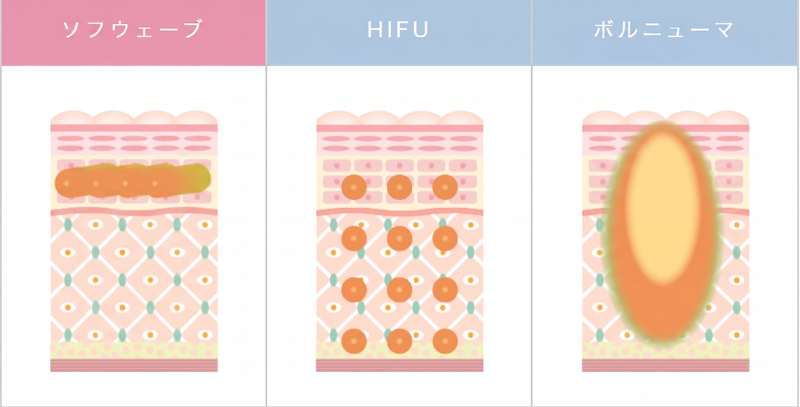 ソフウェーブ・ハイフ・ボルニューマの違い