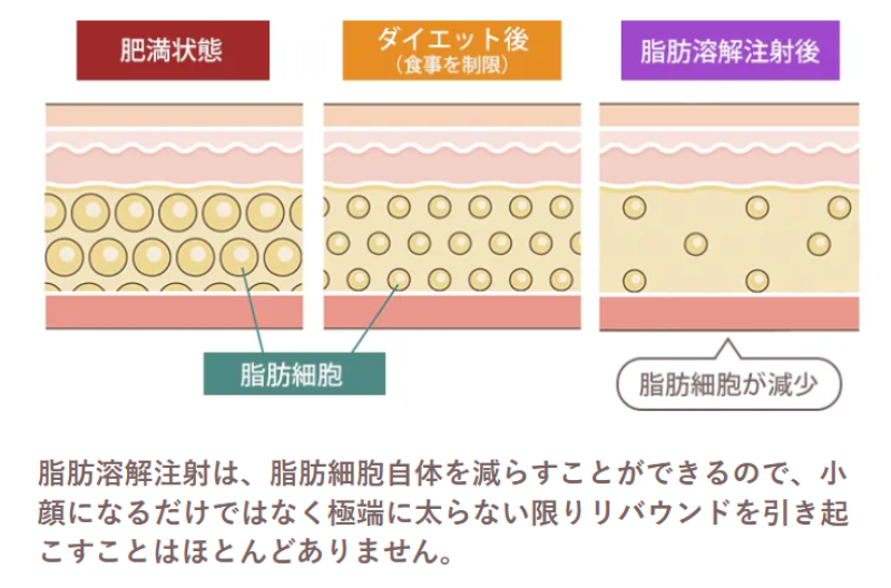 TCB脂肪溶解注射効果