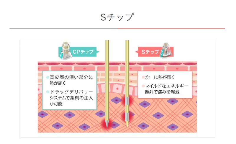 ポテンツァのSチップ