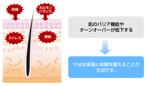 ニキビ・ニキビ跡の原因